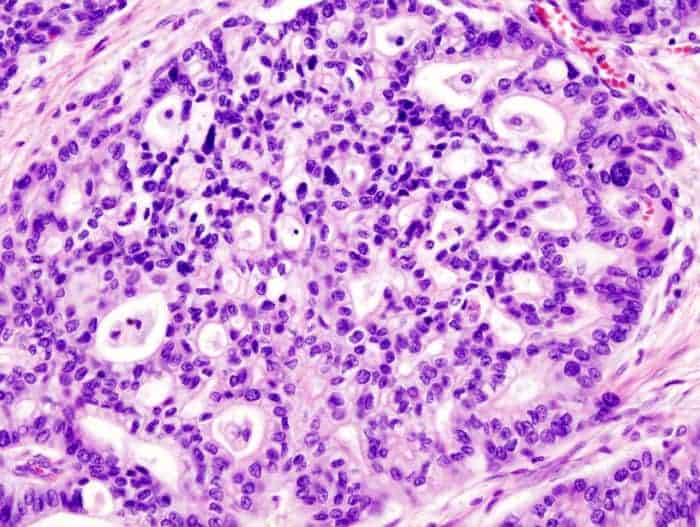 Pancreatic Adenocarcinoma