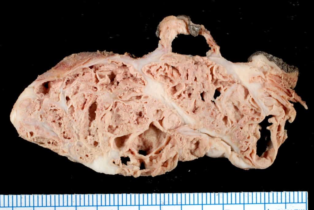 Calcinosis of Chronic Renal Failure