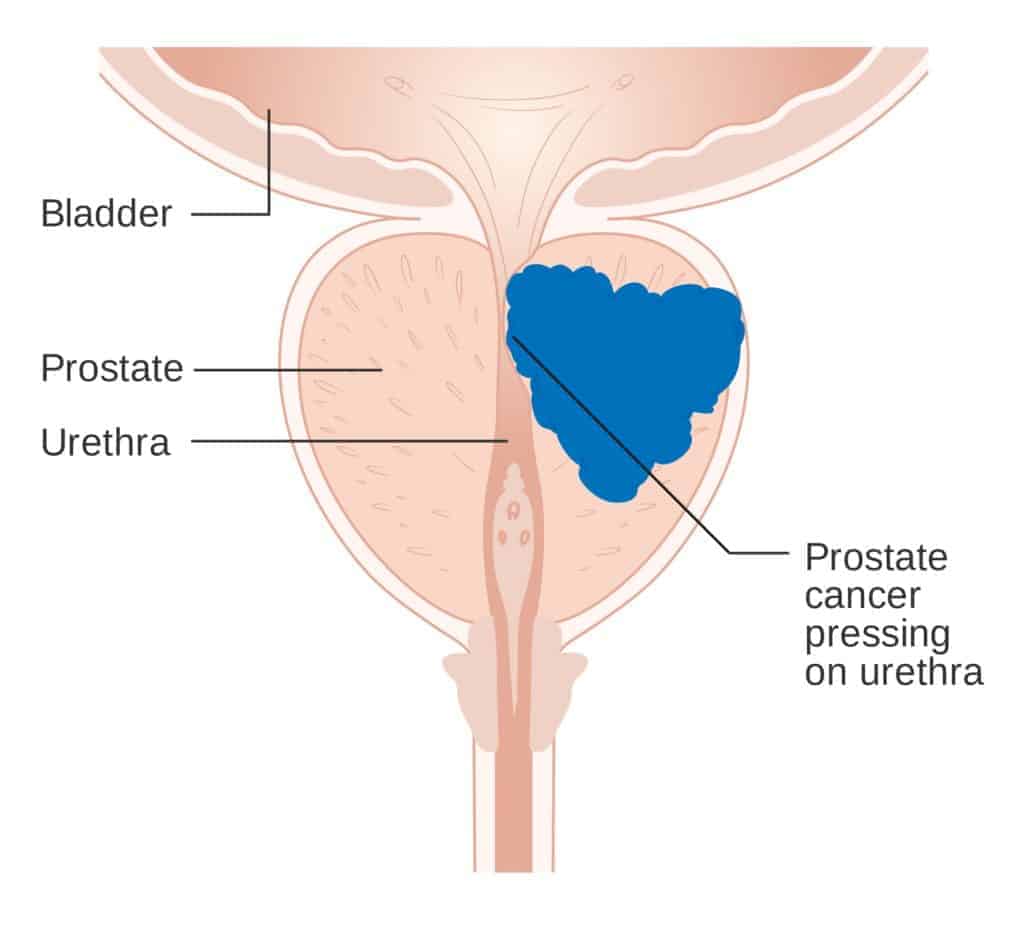 prostate cancer